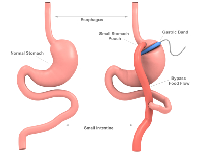 Steve Parker MD, bariatric surgery, gastric bypass